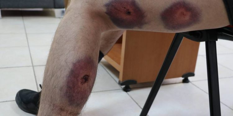 Polîsên dagirker ciwanê HDP’î bi guleyên plastîk birîndar kir