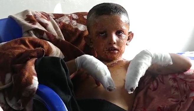 Birîndarên li Hesekê: Dewleta tirk a dagirker bi fosforê êrîşî me kir